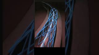 3D Animation Shows How Angioplasty Opens Artery Blockage [upl. by Chaney]