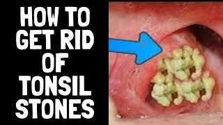 Tonsil Stones  How To Remove Them [upl. by Osborn111]