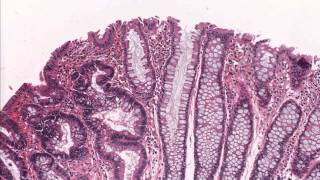 Colon tubular adenoma demonstrating low grade dysplasia  Microscopic diagnosis [upl. by Kerin832]