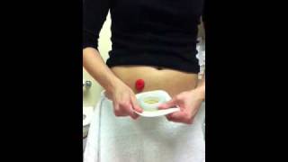 Ostomy pouch change using ConvaTec moldable [upl. by Nylehtak]