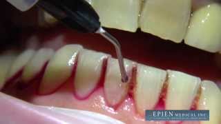 HybenX Supra Gingival Application [upl. by Ideih]