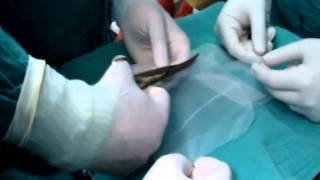 How to Selftailor a 1515 cm polypropylene monofilament mesh for cystocele transvaginal repair [upl. by Trimble]