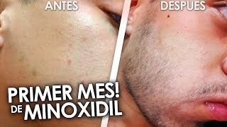 MI PRIMER MES USANDO MINOXIDIL [upl. by Ainniz]