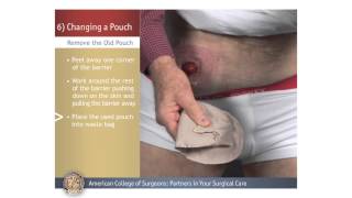 ColostomyIleostomy Changing a Pouch [upl. by Arimas]