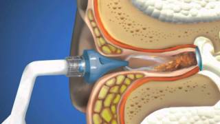 Bionix® OtoClear® Ear Irrigation [upl. by Kimbell]