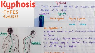 Kyphosis types and causes [upl. by Nimocks114]