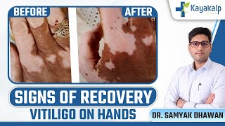 हाथों पर सफेद दाग Vitiligo का इलाज  Vitiligo on Hands Treatment in Hindi  Kayakalp Global [upl. by Nodnab]