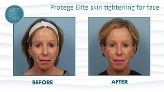 Protege Elite Radiofrequency for Skin Tightening [upl. by Neerhtak]