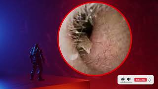 The Truth About earwax Will Shock You How to remove earwax from ear earwax extractions [upl. by Ynnal]