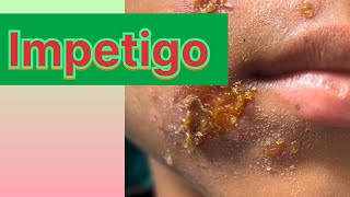 Impetigo in childrenबच्चो में होने बाले फोड़े फ़िन्सी [upl. by Devine]