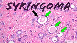 Syringoma 5Minute Pathology Pearls Tadpole  Paisley Tie Pattern Dermpath Dermatology [upl. by Bouton543]