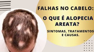 O que é alopecia areata sintomas causas e tratamento [upl. by Ashbey]