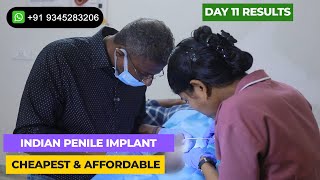 PostOp Recovery  Penile Implant Suture Removal  Day 11 in India [upl. by Olwena]