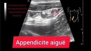 Appendicite aiguë Epanchement Adénopathies mésentériques Échographie Appendicitis [upl. by Doreg609]