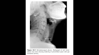 Acute retropharyngeal abscess [upl. by Tray]