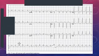 Recognizing and Managing Atrial Flutter in the Emergency Department  ECG Case Study [upl. by Atener835]