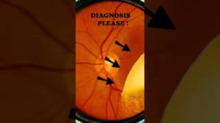 Diabetic retinopathy  Vitreous  Hard exudates  Fundus  Short Video 192 [upl. by Mallis]