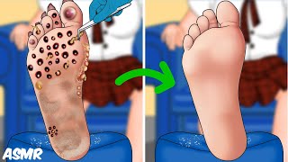 ASMR Remove foots Infections  Maggot Infested toes Removal  발 감염 제거  구더기가 득실거리는 발가락 제거 [upl. by Timothy278]