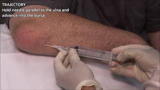 Olecranon Bursitis  Aspiration and Injection  In Vivo Series [upl. by Oremar]