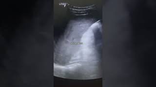 Hepatic calcification on USGcomedy usg trending baby usgsfactsviralvideoshorts youtubeshort [upl. by Negam]