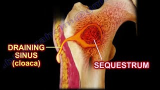 Pathology 825 f Pyogenic Osteomyelitis Pathogenesis Gross Involucrum Brodies abscess [upl. by Cally]