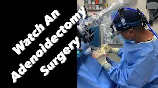 Adenoidectomy  actual footage [upl. by Goldia704]