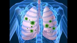 8 síntomas de la pulmonía que no puedes ignorar [upl. by Alohs598]