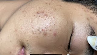 ACNE TREATMENT VU QUYNH MI Acne On Boys Chin 2024 [upl. by Enirac433]