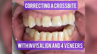 Crossbite corrected with Invisalign and 4 veneers crossbite invisalign veneers [upl. by Irbua]