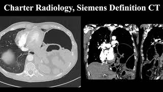 CT Chest With Contrast Left Diaphragm Defect [upl. by Wack20]