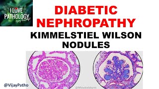 DIABETIC NEPHROPATHY Pathophysiology amp Morphology [upl. by Eileme437]