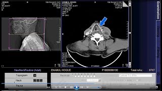 CT scan of larynx and hypopharynx Neck format [upl. by Eselahc]