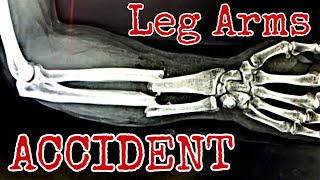 Leg Arms quotArmquot Crushed｜How It Happened [upl. by Dammahom]