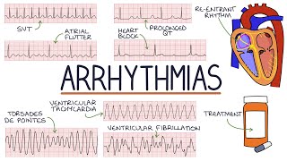 Understanding Arrhythmias [upl. by Gwendolin]