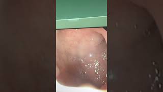 Upper endoscopy of a child with persistent vomiting one year ago showing gastritis and duodenitis [upl. by Emeline]