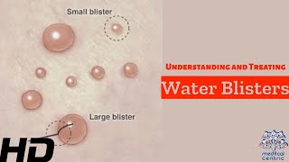 Water Blisters Unveiled Causes Treatment and Prevention [upl. by Korry]