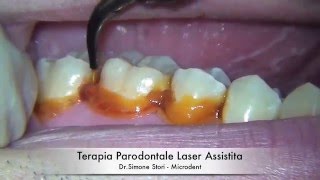 Terapia Parodontale Laser Assistita [upl. by Limaj]