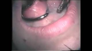 Dental laser treatment video 3 [upl. by Aikkin]