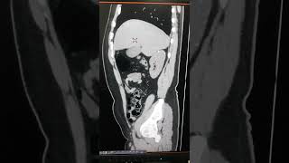 Nephrocalcinosis nephrocalcinosisctscan kidney noncontrastctscankub [upl. by Yenoh207]