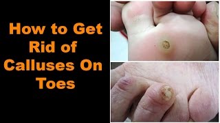 How to Get Rid of Calluses on Toes  6 Ways to Remove Calluses Naturally [upl. by Llebanna]