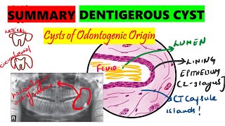 Dentigerous cyst  10 minute SUMMARY  Histopathology  Clinical features  Radiographic features [upl. by Kerwin]