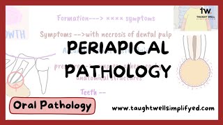 Periapical cyst  symptoms diagnosis differential diagnosis treatment theories of cyst formation [upl. by Gylys860]