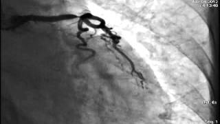 Distal LMCA Bifurcation stenting [upl. by Haneehs520]