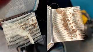 CloseUp Of Lice Infestation Removal [upl. by Pernick340]