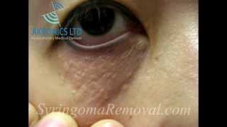 What is syringoma [upl. by Anairda28]