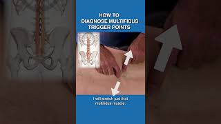 How to diagnose multifiidus Triggers [upl. by Annaet]