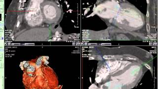 Coronary CT Angiography Mass [upl. by Einafets]