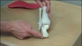 Supinated Foot  Foot Orthotic [upl. by Pliam]