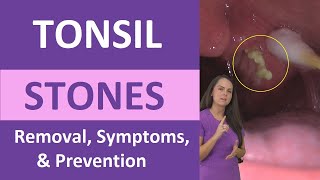 Tonsil Stones Removal Causes Symptoms Cotton Swab Treatment [upl. by Forsyth]