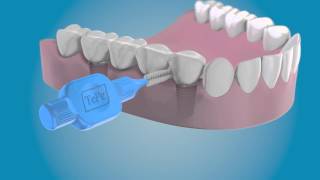 Clean the sides of your dental implants with a TePe Interdental Brush [upl. by Etnahs]